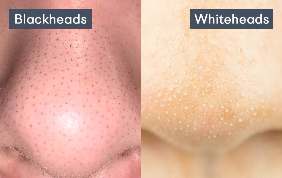Blackheads vs. Whiteheads: What’s the Difference?
