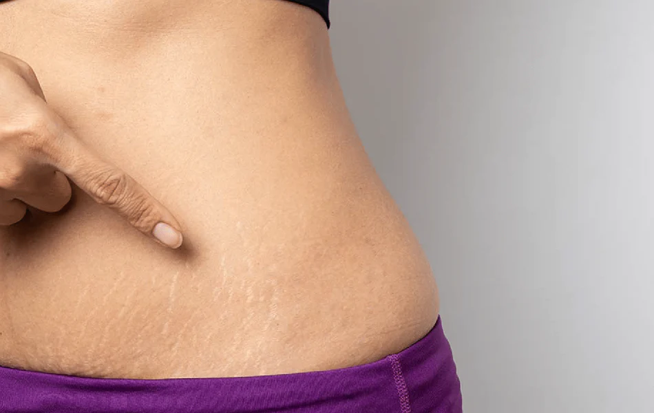 How to Prevent Pregnancy Stretch Marks?